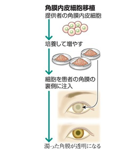 日本确认移植角膜内皮细胞安全有效