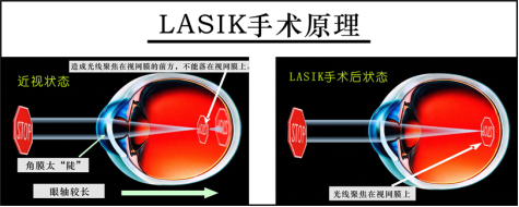 拯救快"瞎"的眼 60年前中国10%近视率 如今飙升90%