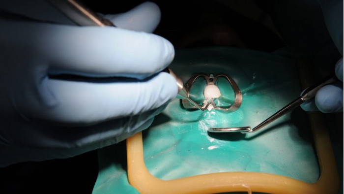 新型可注射水凝胶可避免接受根管治疗的牙齿死亡