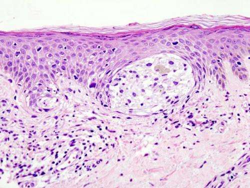 PNAS：科学家们开发出治疗黑色素瘤的肿瘤疫苗