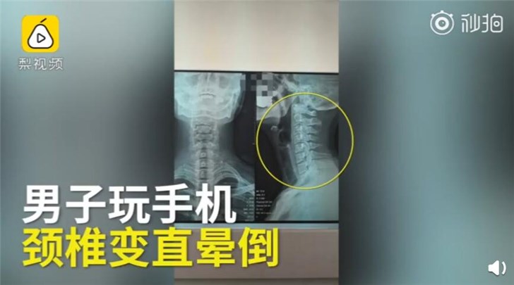 男子每天玩6小时手机颈椎变直：在家突然晕厥