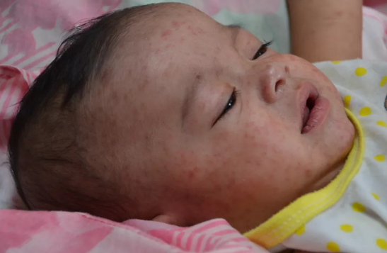 美疾控中心：麻疹疫情持续 今年已有1022人感染