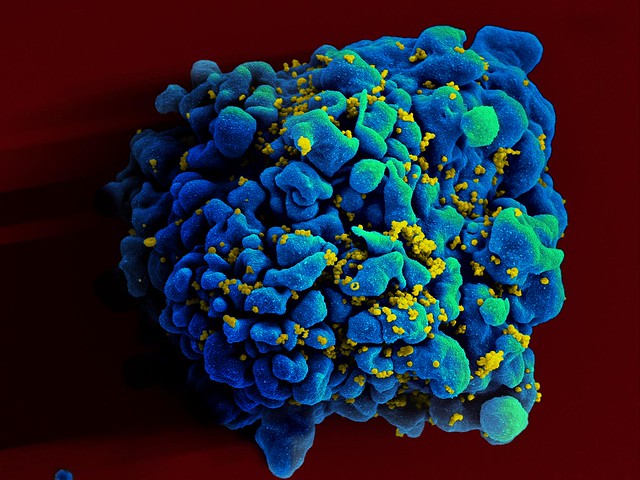 科学家让重新编程过的免疫细胞具备杀死HIV感染T细胞的能力