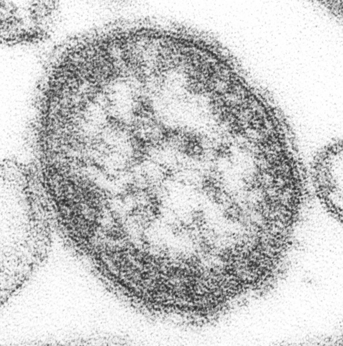 远超埃博拉 麻疹已致刚果（金）超5000人死亡