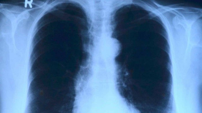 耶鲁大学研究人员已经绘制出人类肺蓝图