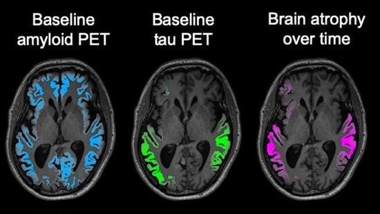 新脑成像技术：可更早预测阿尔茨海默病相关疾病