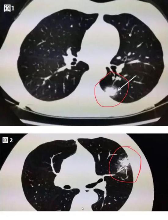 新冠病毒到底对患者的肺做了什么？