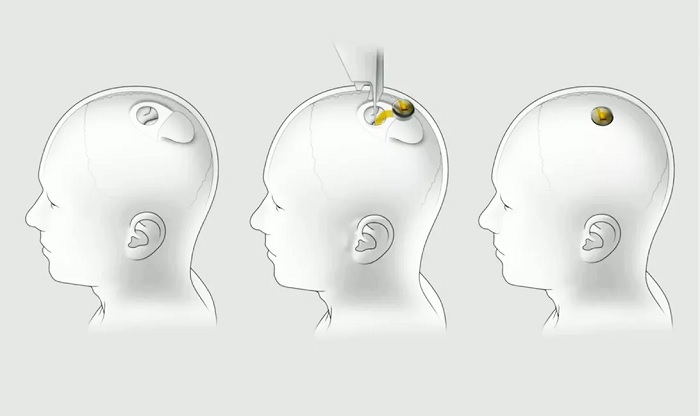 马斯克在猪身上展示Neuralink脑机接口最新技术