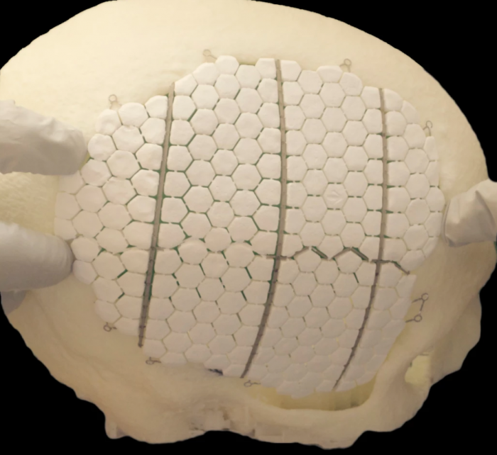 瑞典科学家研发生物陶瓷植入物 可刺激受损颅骨再生