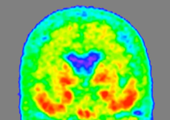 科学家开发新技术 在脑脊液中追踪引发阿尔茨海默病的“罪魁祸首”