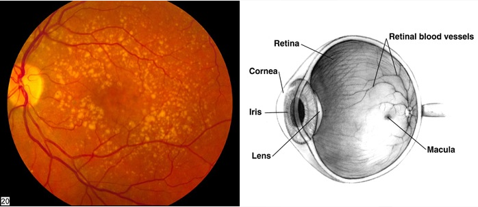 新型生物混合人工视网膜有望借助活细胞恢复患者视力