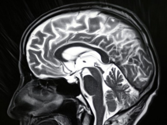 继发性感染引发的脑炎会使阿尔茨海默病的认知和记忆恶化