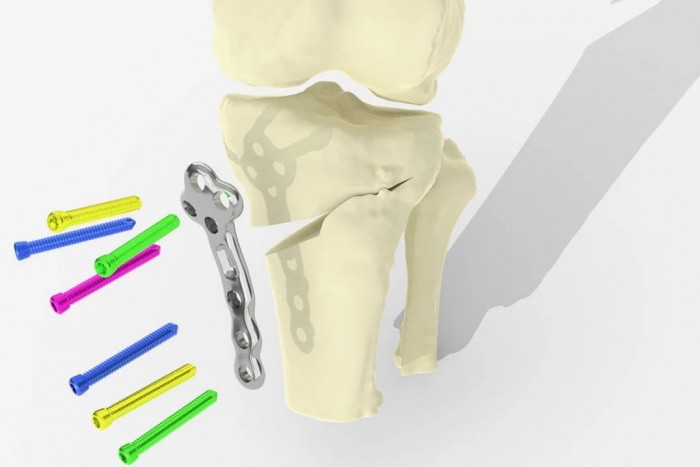 关节炎患者福音：利用3D打印让膝关节手术更好更快