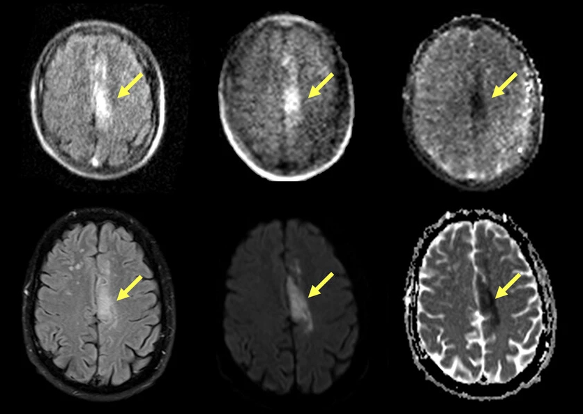 便携式核磁共振成像设备可准确检测最常见的中风形式