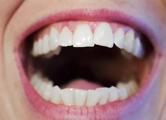 新研究发现牙龈疾病跟阿尔茨海默病之间的惊人联系