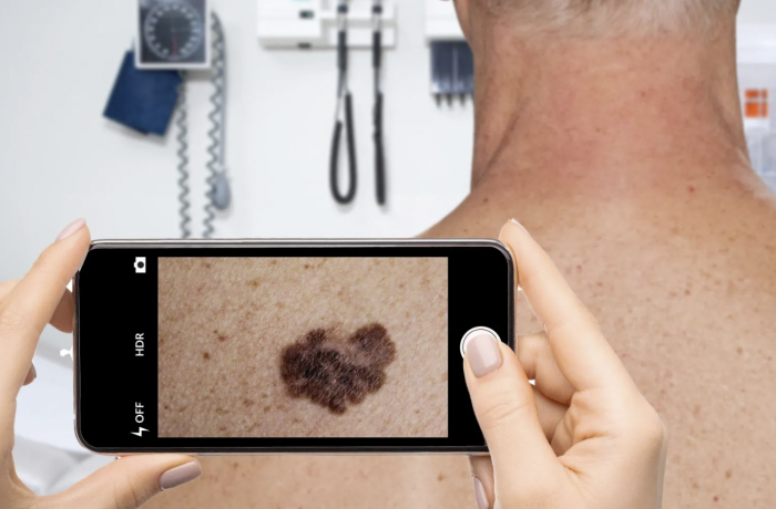 新App使用人工智能对皮肤状况进行分类并且进行准确诊断