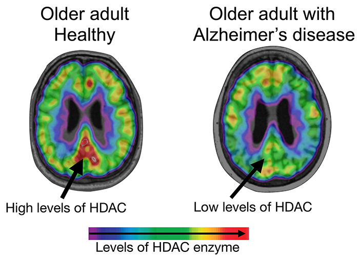 研究：随着阿尔茨海默病的发展，大脑中调节DNA折叠的酶的水平出现下降